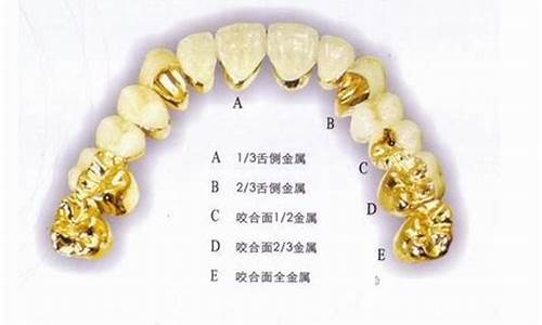 贵金属烤瓷牙和普通烤瓷牙_贵金属烤瓷合金价钱